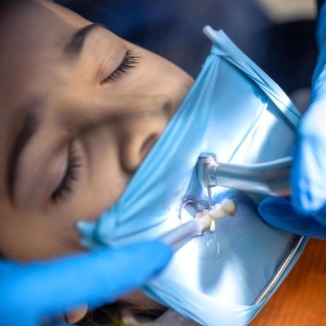 Endodontics root canal treatment at Secunderabad Dental Hospital
